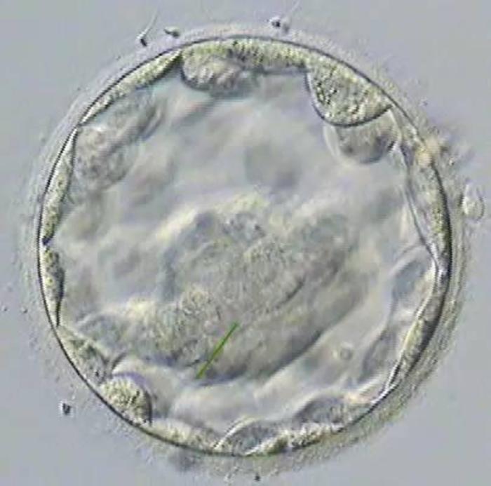 微创无痛人流手术