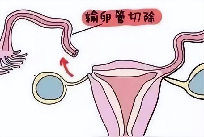 怀孕一个月怎么办才能打掉